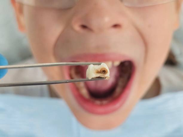 Best Emergency Broken Tooth Repair in Skyline Ganipa, NM